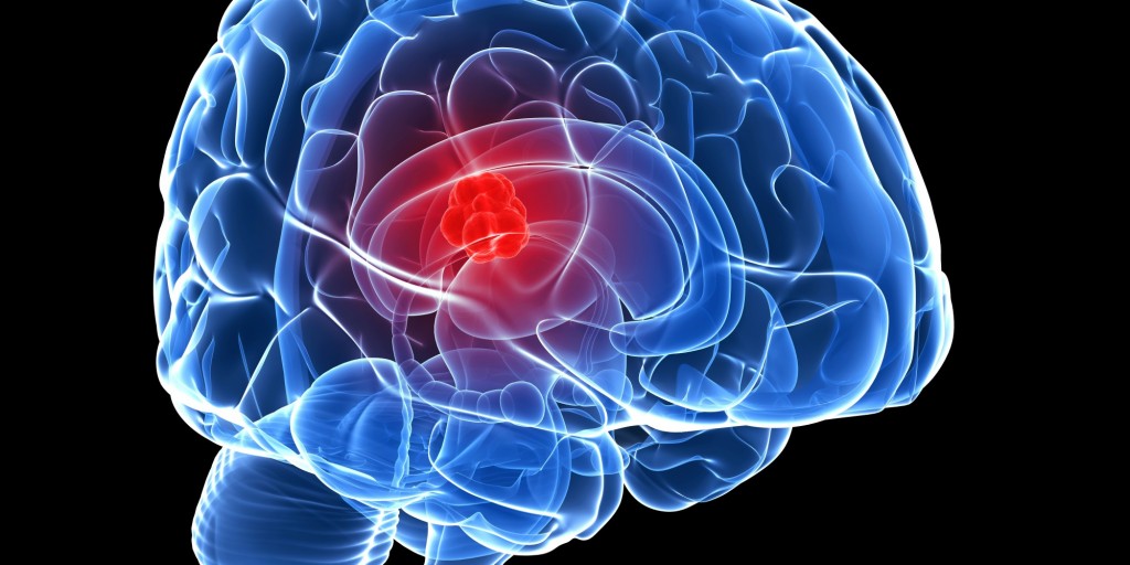 “Pruebas de Fase 0”, cambian las reglas del juego en cuanto a tratamiento para combatir tumores cerebrales