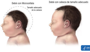 "Esta es la noticia que temíamos", comentó recientemente de Edward R.B. McCabe, MD, PhD, vicepresidente ejecutivo y director médico de March of Dimes sobre la transmisión local por mosquito del virus Zika en Florida y los riesgos que esto plantea para las mujeres embarazadas y sus bebés. Es sólo una cuestión de tiempo antes de que los bebés nazcan con microcefalia, un defecto cerebral grave, debido a la transmisión local del Zika en el territorio continental de Estados Unidos.